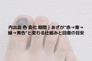 内出血 色 変化 期間｜あざが“赤→青→緑→黄色”と変わる仕組みと回復の目安