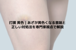 打撲 黄色｜あざが黄色くなる意味と正しい対処法を専門家視点で解説